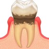 歯周病　敗血症の危険性